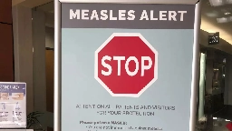 AHS confirms case of measles in Edmonton | CityNews Edmonton